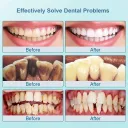 Photo 4 — Ultrasonic Dental Scaler PEICON N-G6 White, Tartar & Stain Removal